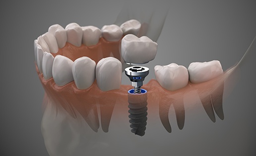 a 3D illustration of the parts of a dental implant